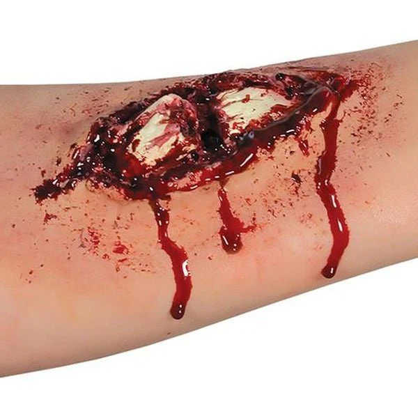 Broken Bone